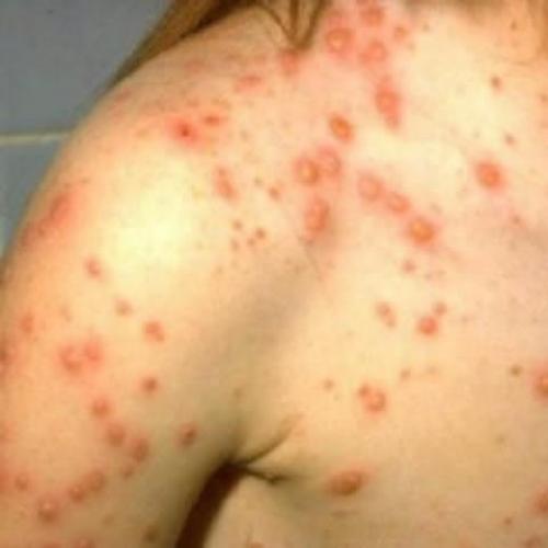 Аллергия сколько сходит сыпь