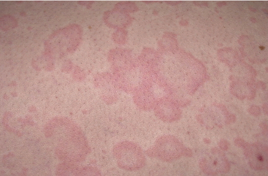 Аллергия высыпания на коже народные