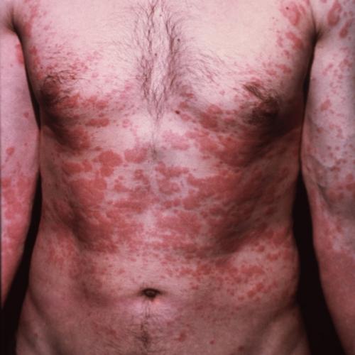 Аллергия как быстро проходит сыпь