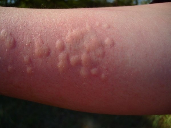 Аллергия высыпания на коже народные