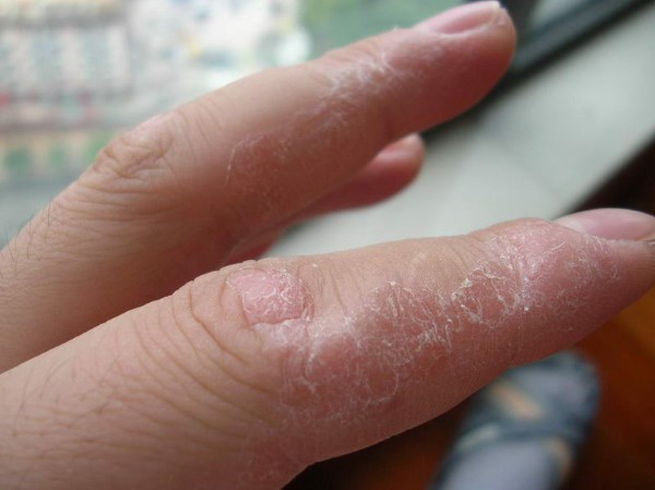 Как бороться с аллергией сыпь
