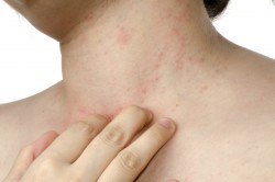 Аллергия как быстро проходит сыпь