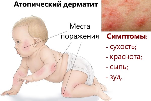 Аллергический дерматит покраснение кожи сыпь кожный зуд